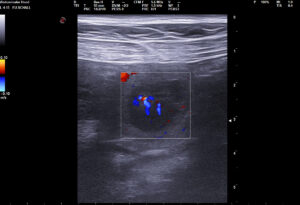 00047545_00098732_DICOM_US_2025_07_11_0000836752