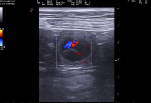00047545_00098732_DICOM_US_2025_07_11_0000836755